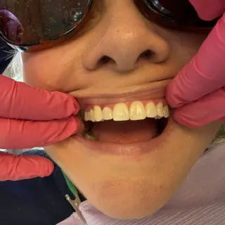 Close-up of a patient's upper teeth after air polishing, showing visibly reduced pink plaque-disclosing stain compared with the before-cleaning image.