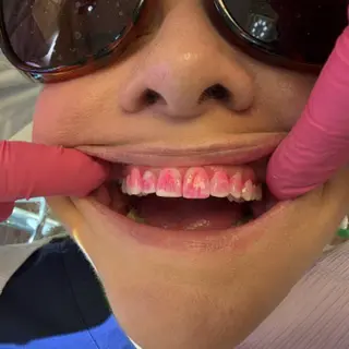 Close-up of a patient's upper teeth before air polishing, showing pink and red plaque-disclosing solution highlighting dental plaque and biofilm.